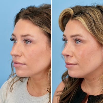 Rhinoplasty Before & After Gallery - Patient 317977 - Image 6