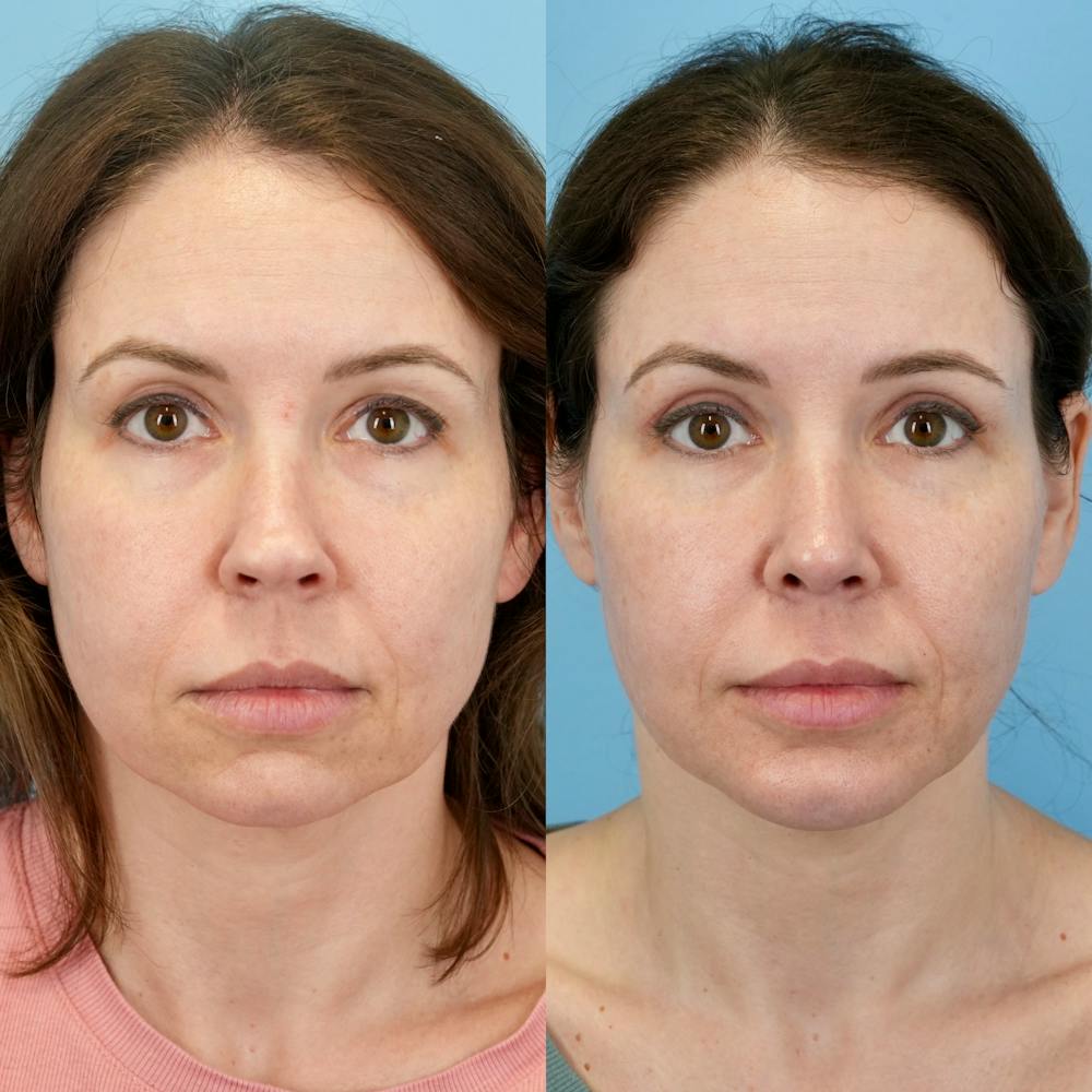 Rhinoplasty Before & After Gallery - Patient 161819 - Image 4