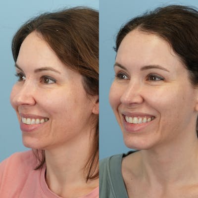 Rhinoplasty Before & After Gallery - Patient 161819 - Image 6
