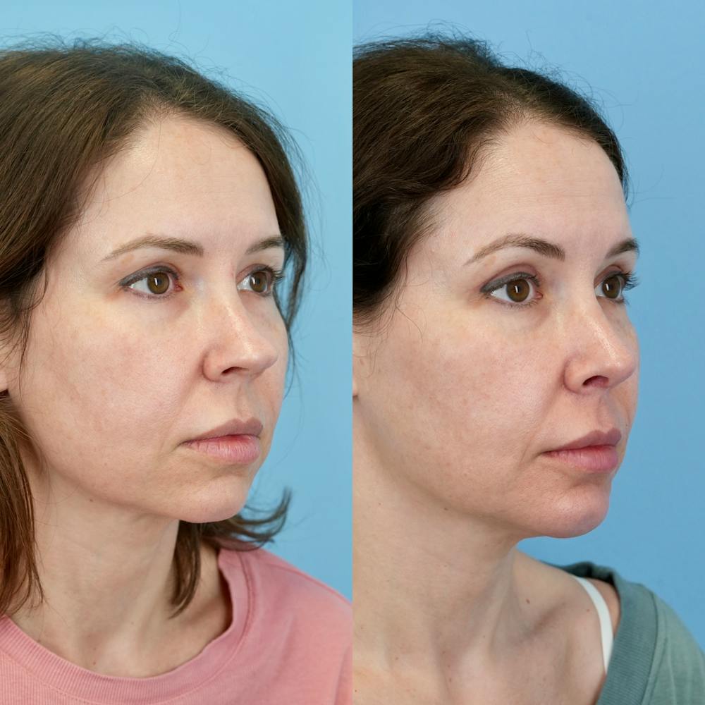 Rhinoplasty Before & After Gallery - Patient 161819 - Image 2
