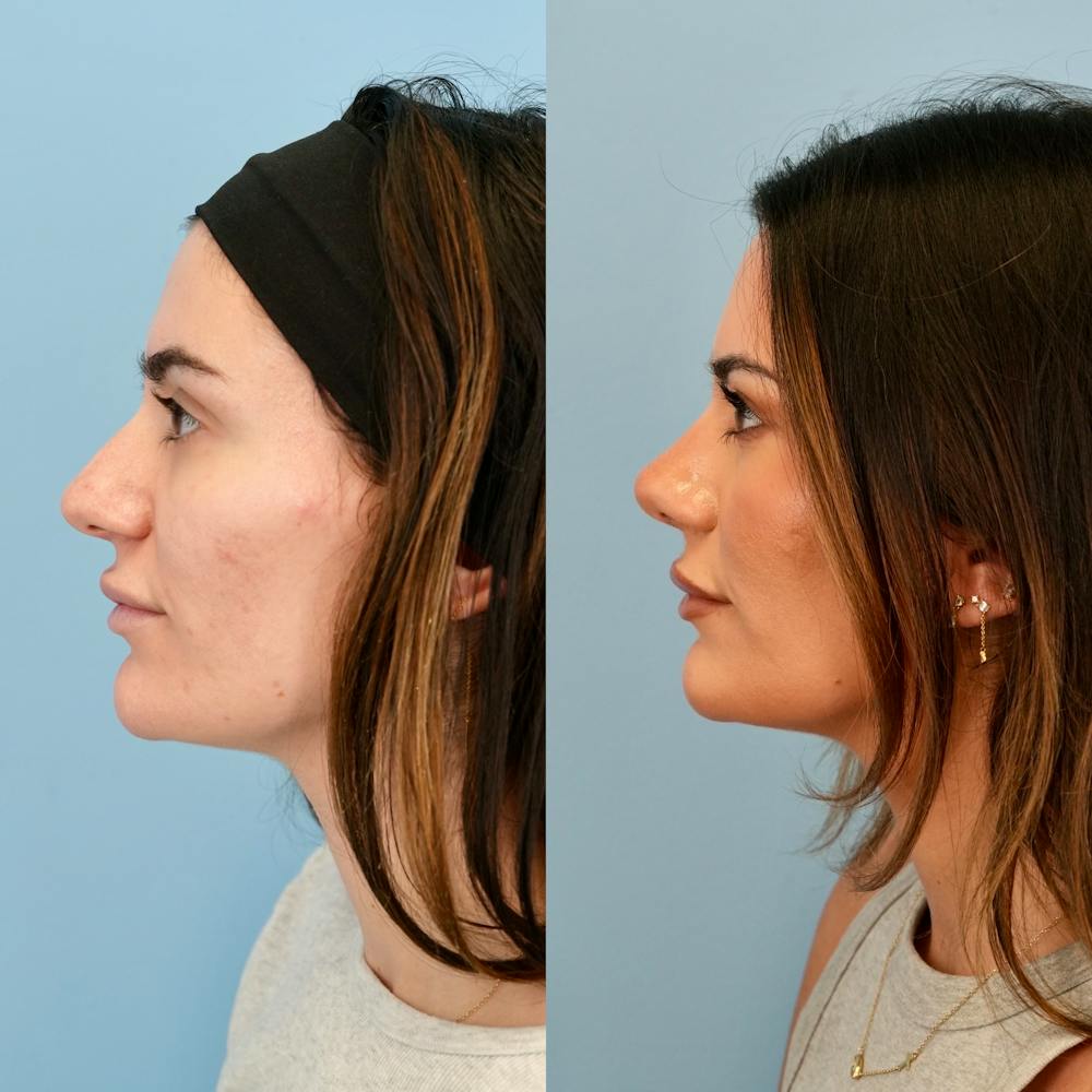 Rhinoplasty Before & After Gallery - Patient 240485 - Image 9