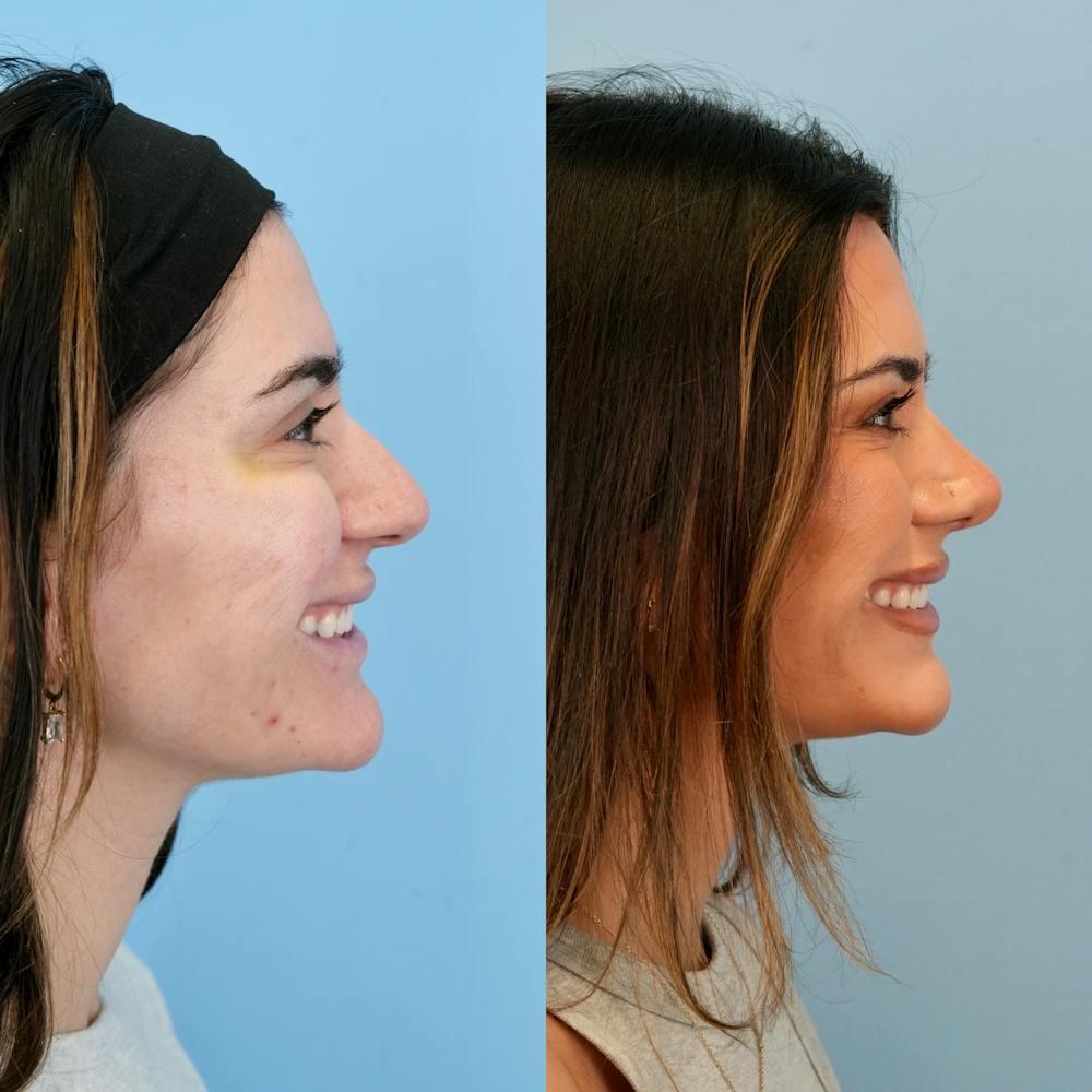Rhinoplasty Before & After Gallery - Patient 240485 - Image 2