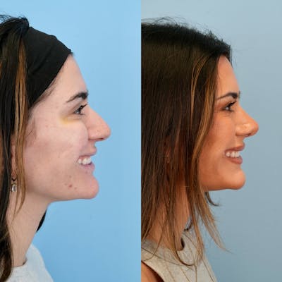 Rhinoplasty Before & After Gallery - Patient 240485 - Image 2
