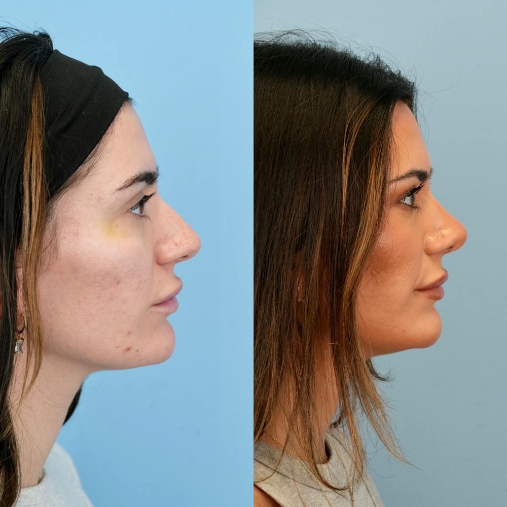 Rhinoplasty Before & After Gallery - Patient 240485 - Image 1