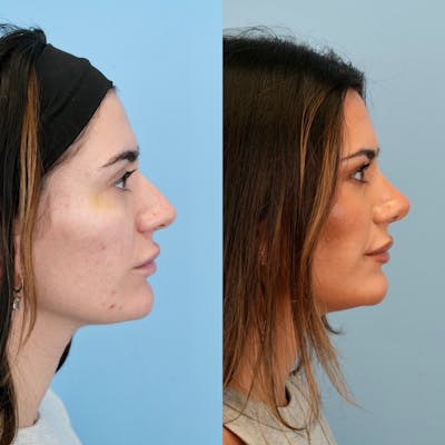 Rhinoplasty Before & After Gallery - Patient 240485 - Image 1