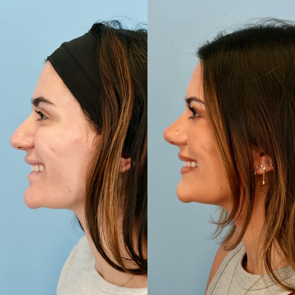 Rhinoplasty Before & After Gallery - Patient 240485 - Image 8
