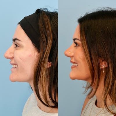 Rhinoplasty Before & After Gallery - Patient 240485 - Image 8