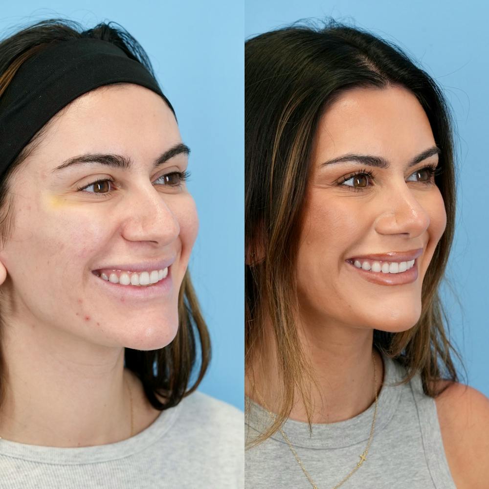 Rhinoplasty Before & After Gallery - Patient 240485 - Image 4