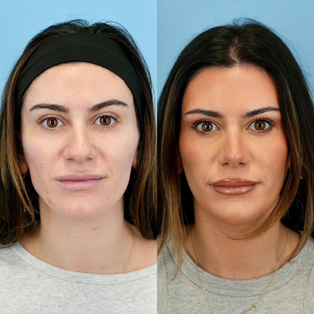 Rhinoplasty Before & After Gallery - Patient 240485 - Image 5
