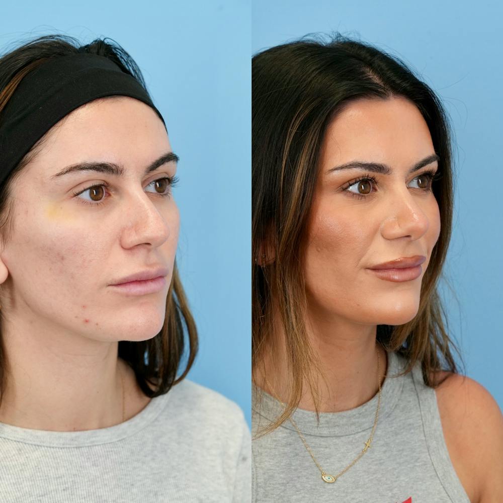 Rhinoplasty Before & After Gallery - Patient 240485 - Image 3