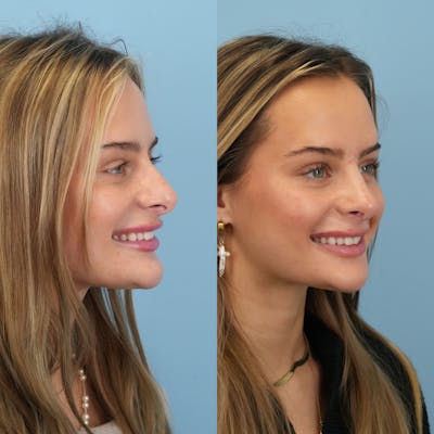 Rhinoplasty Before & After Gallery - Patient 940717 - Image 4