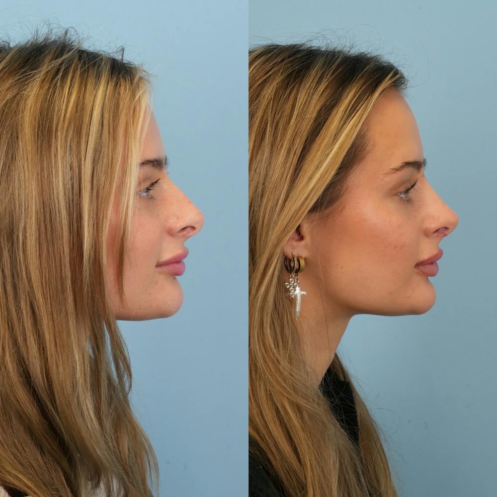 Rhinoplasty Before & After Gallery - Patient 940717 - Image 1