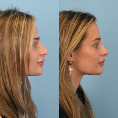 Rhinoplasty Before & After Gallery - Patient 940717 - Image 1