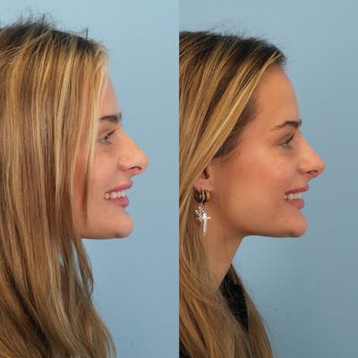 Rhinoplasty Before & After Gallery - Patient 940717 - Image 2
