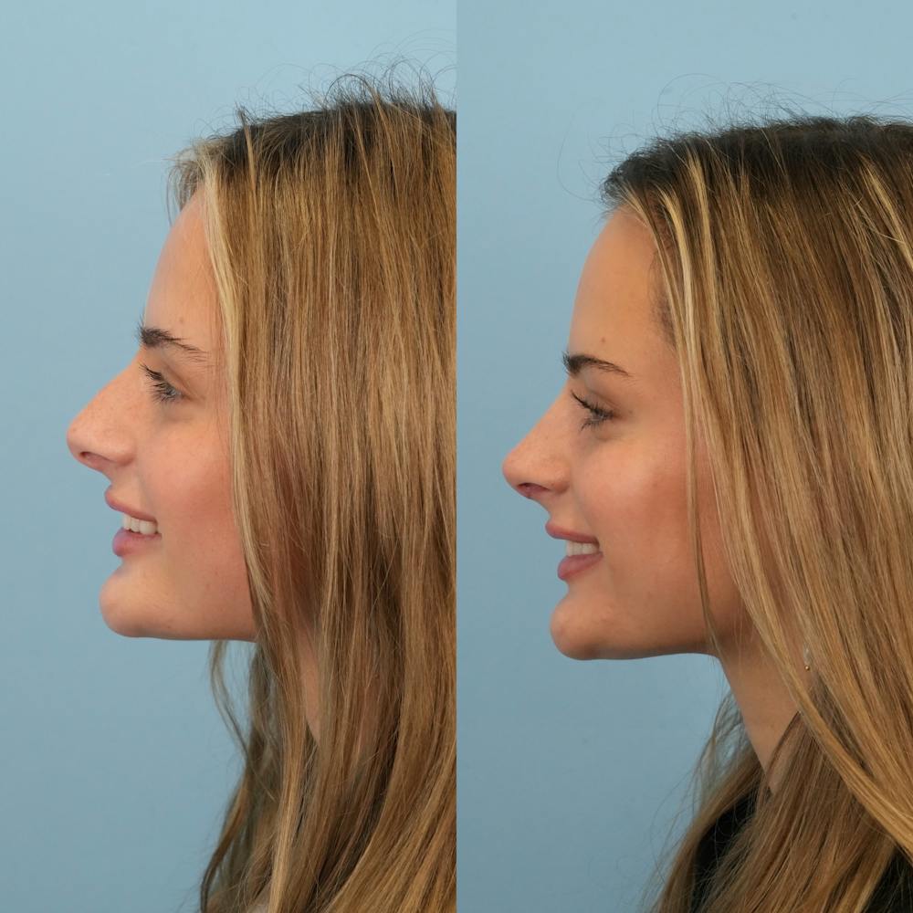 Rhinoplasty Before & After Gallery - Patient 940717 - Image 9