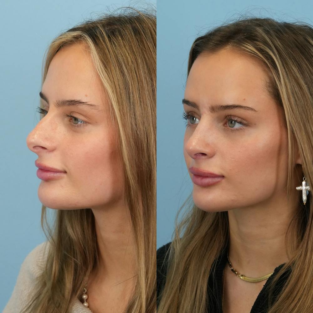 Rhinoplasty Before & After Gallery - Patient 940717 - Image 6