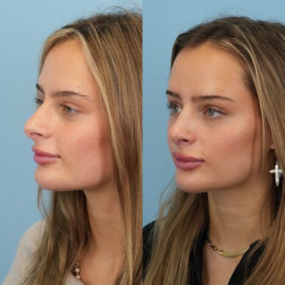 Rhinoplasty Before & After Gallery - Patient 940717 - Image 6