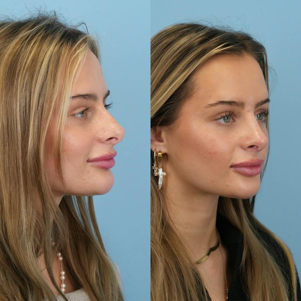 Rhinoplasty Before & After Gallery - Patient 940717 - Image 3