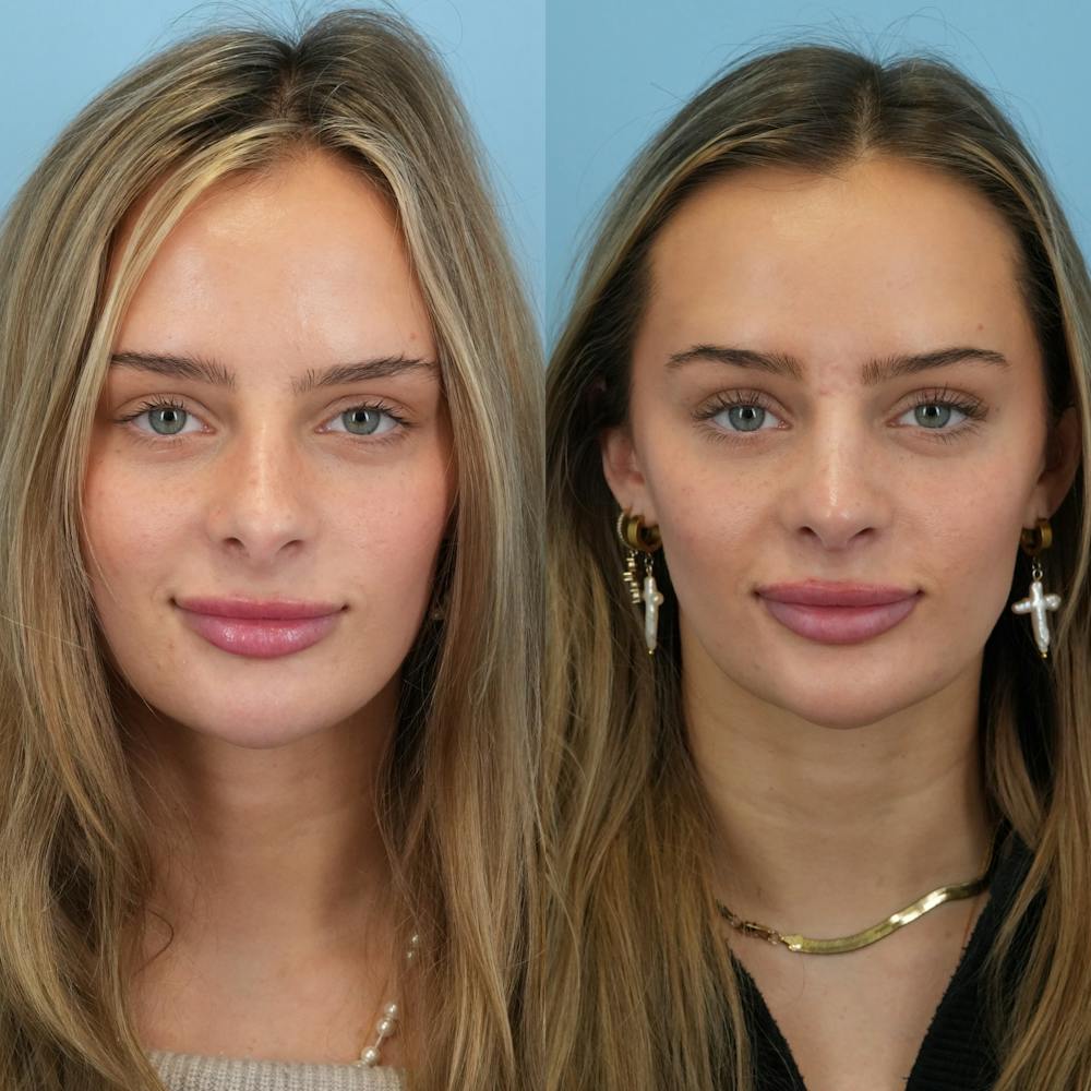 Rhinoplasty Before & After Gallery - Patient 940717 - Image 5