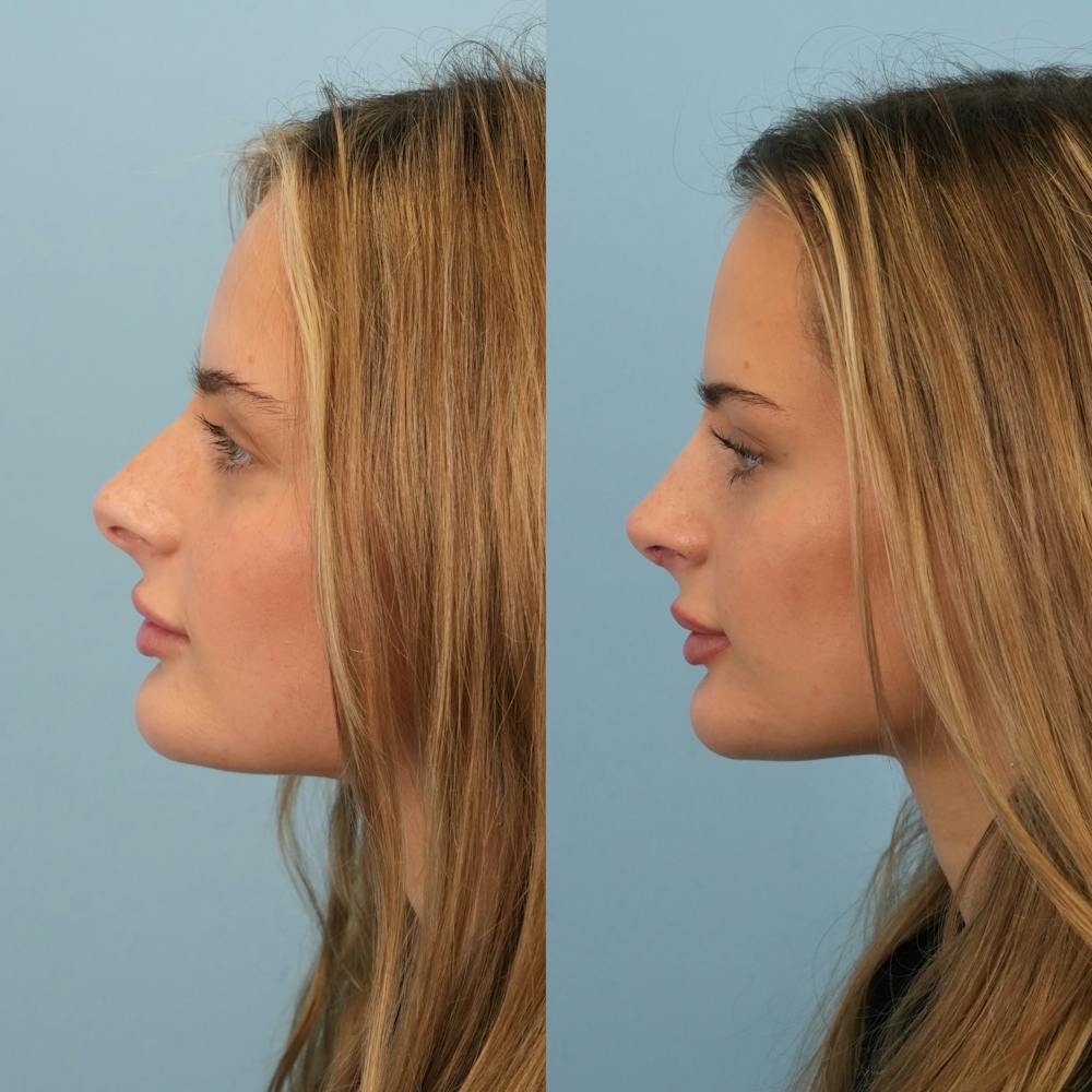 Rhinoplasty Before & After Gallery - Patient 940717 - Image 8