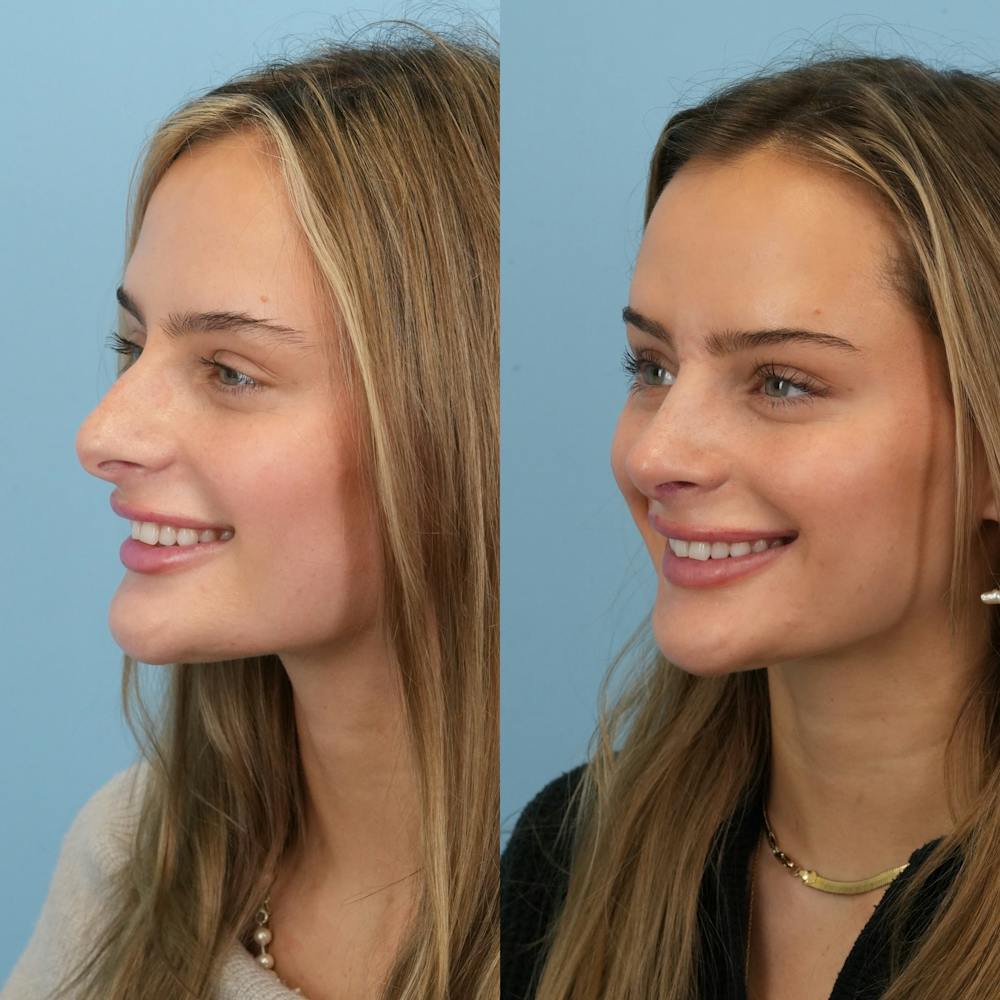 Rhinoplasty Before & After Gallery - Patient 940717 - Image 7
