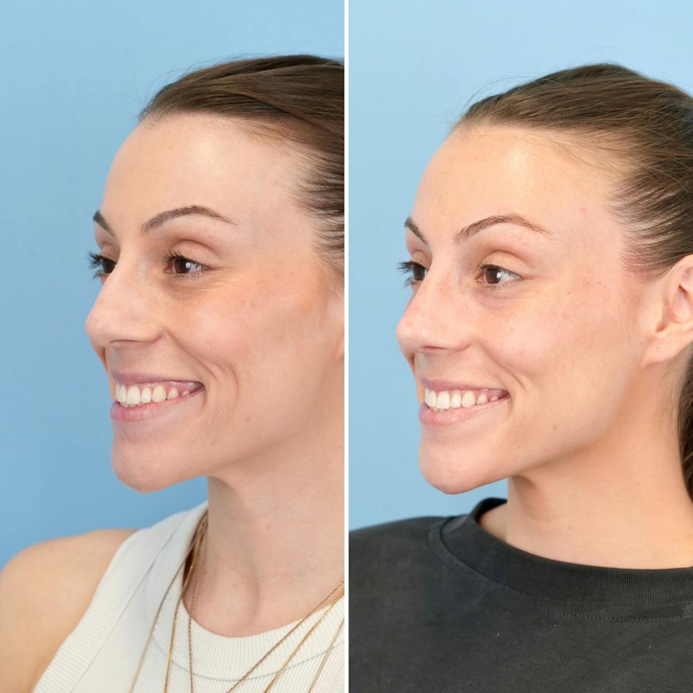 Rhinoplasty Before & After Gallery - Patient 209999 - Image 7