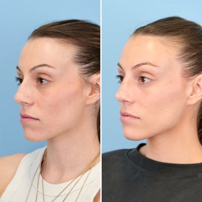 Rhinoplasty Before & After Gallery - Patient 209999 - Image 6