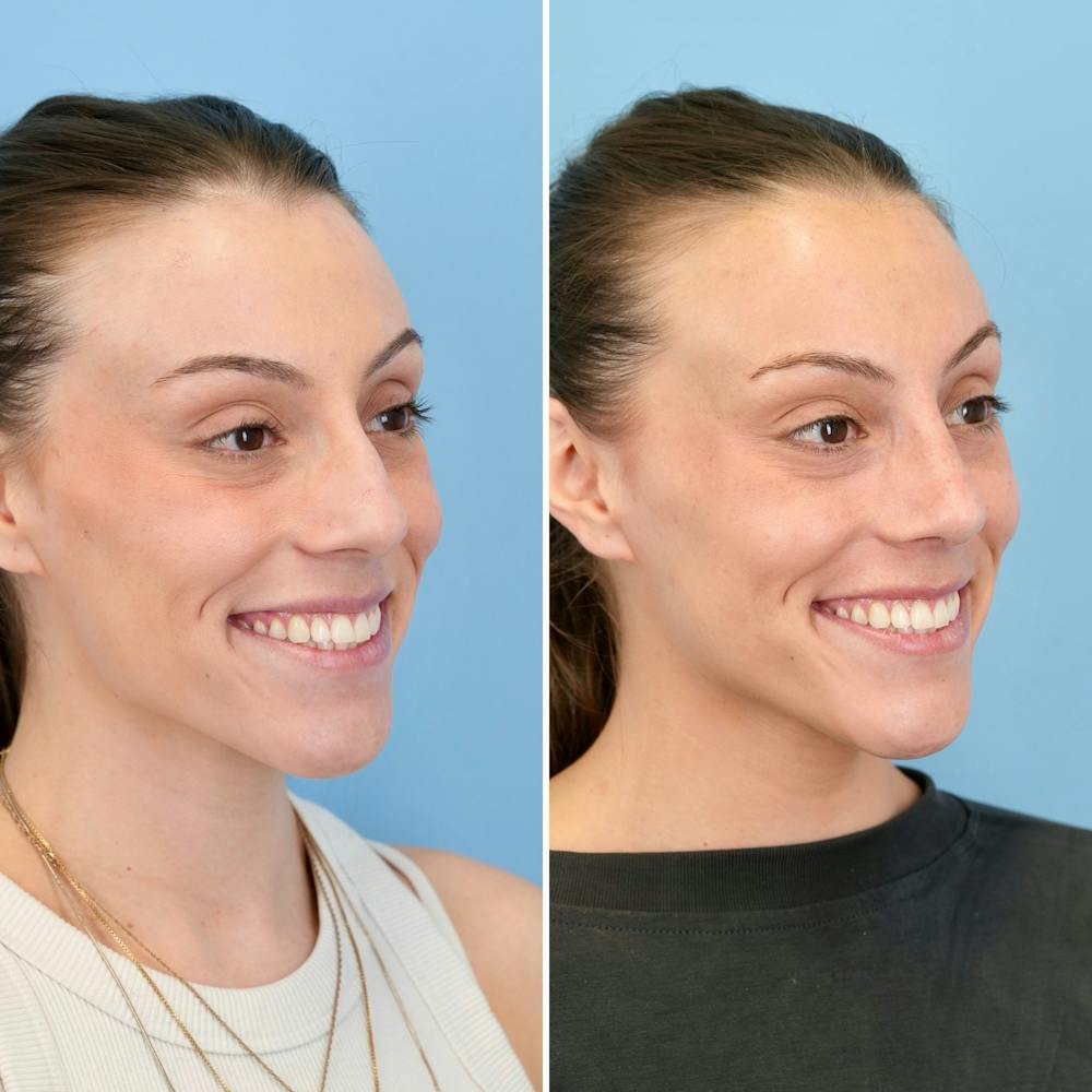 Rhinoplasty Before & After Gallery - Patient 209999 - Image 4