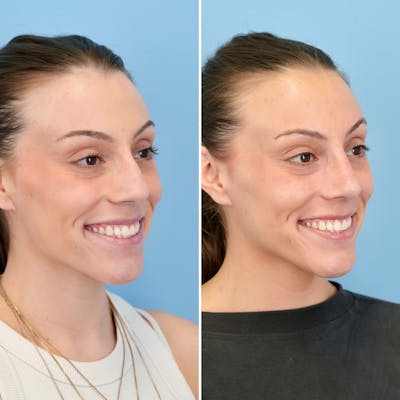 Rhinoplasty Before & After Gallery - Patient 209999 - Image 4