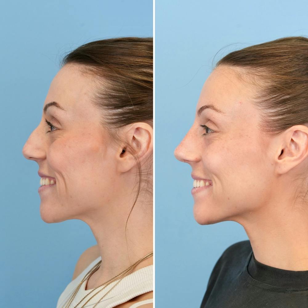 Rhinoplasty Before & After Gallery - Patient 209999 - Image 9