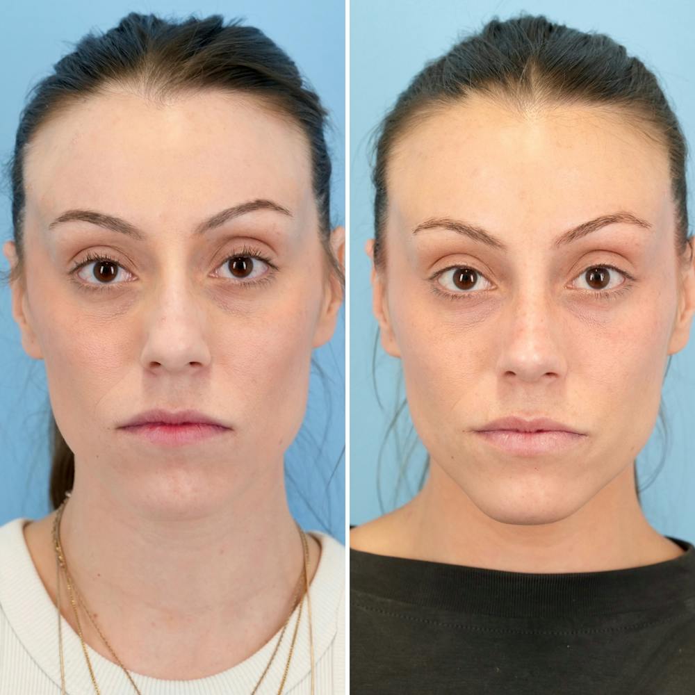 Rhinoplasty Before & After Gallery - Patient 209999 - Image 5