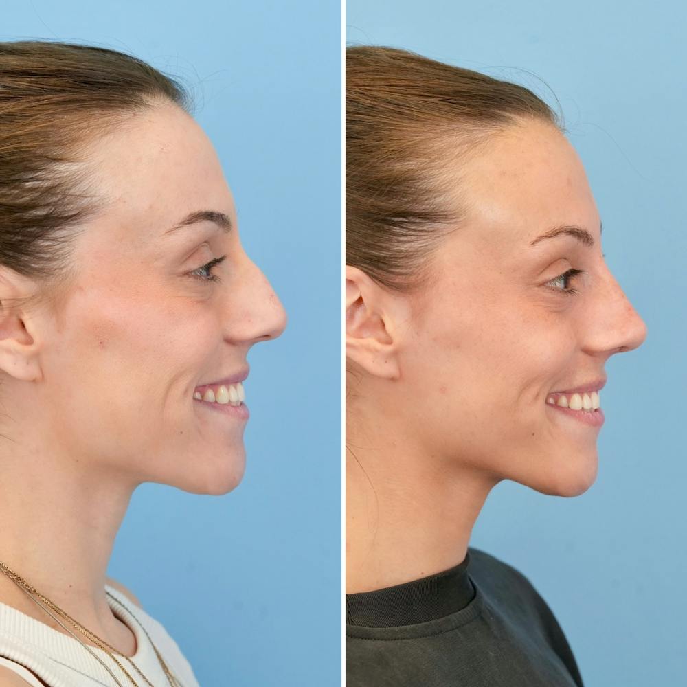 Rhinoplasty Before & After Gallery - Patient 209999 - Image 2