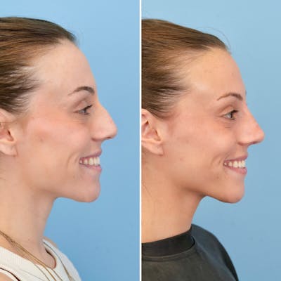 Rhinoplasty Before & After Gallery - Patient 209999 - Image 2