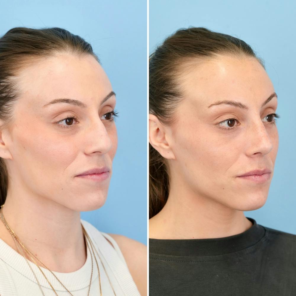Rhinoplasty Before & After Gallery - Patient 209999 - Image 3