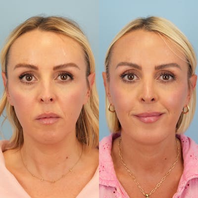 Chin Implants Before & After Gallery - Patient 119400 - Image 4