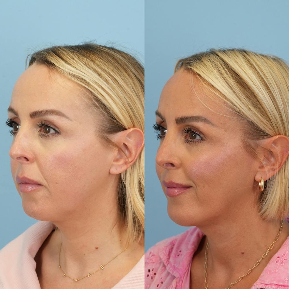 Chin Implants Before & After Gallery - Patient 119400 - Image 3