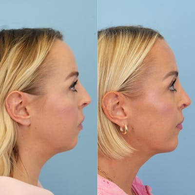 Chin Implants Before & After Gallery - Patient 119400 - Image 6