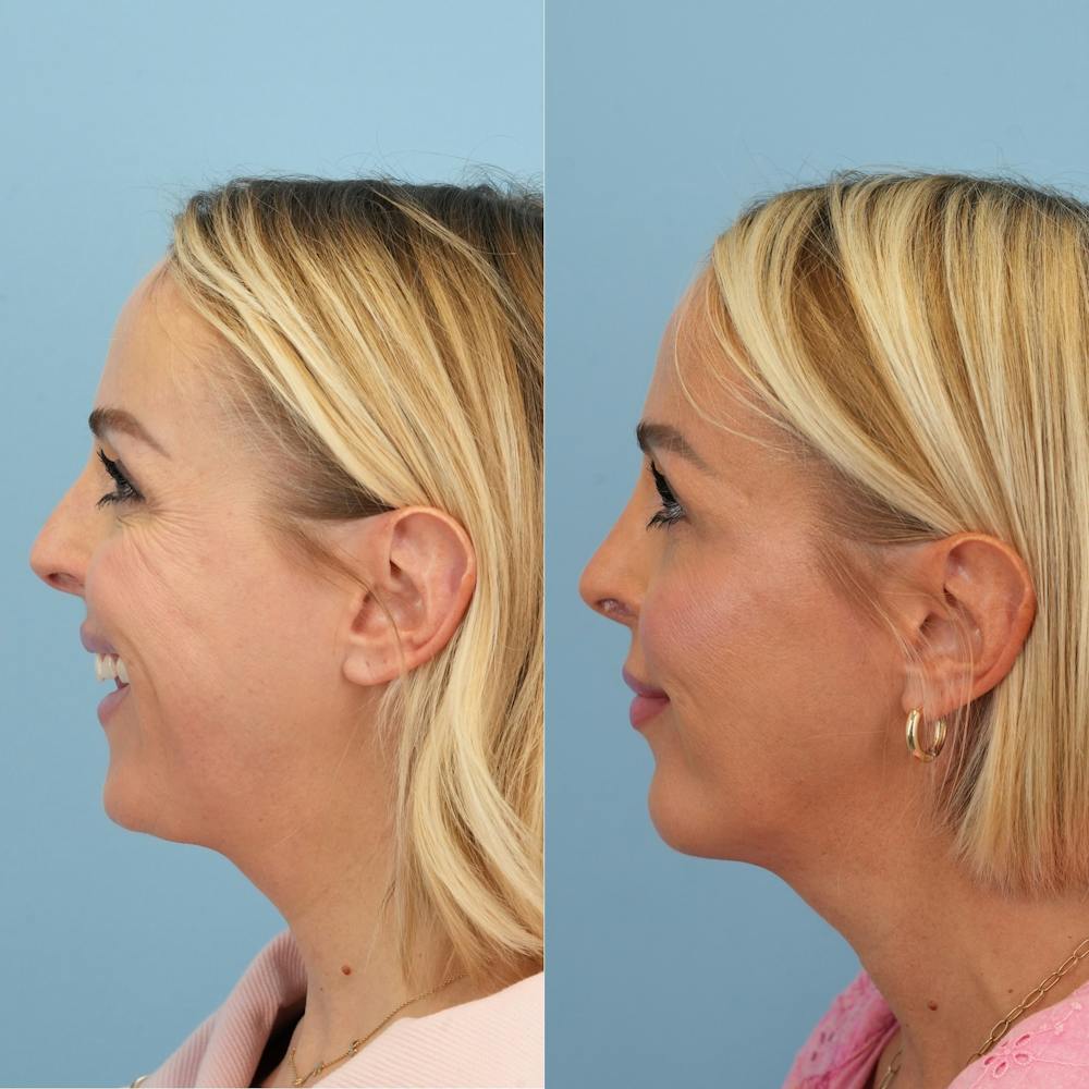 Chin Implants Before & After Gallery - Patient 119400 - Image 2