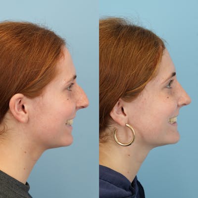 Blepharoplasty Before & After Gallery - Patient 221485 - Image 4