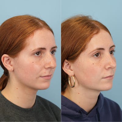 Blepharoplasty Before & After Gallery - Patient 221485 - Image 2