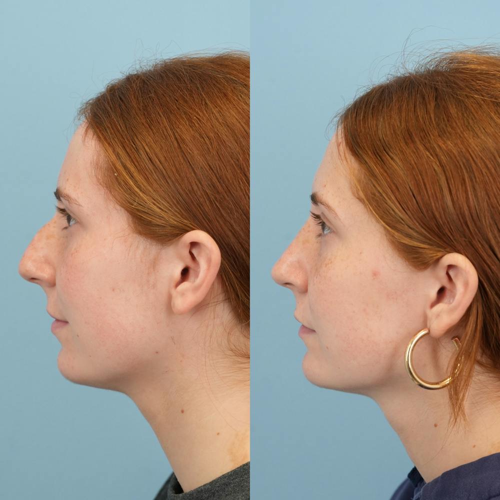 Blepharoplasty Before & After Gallery - Patient 221485 - Image 6