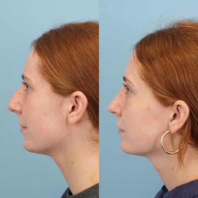 Blepharoplasty Before & After Gallery - Patient 221485 - Image 6