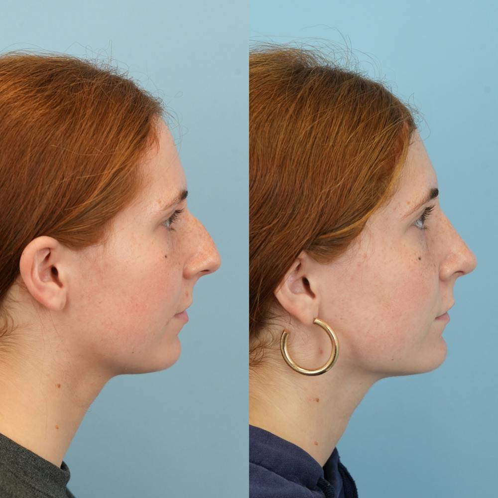 Blepharoplasty Before & After Gallery - Patient 221485 - Image 3