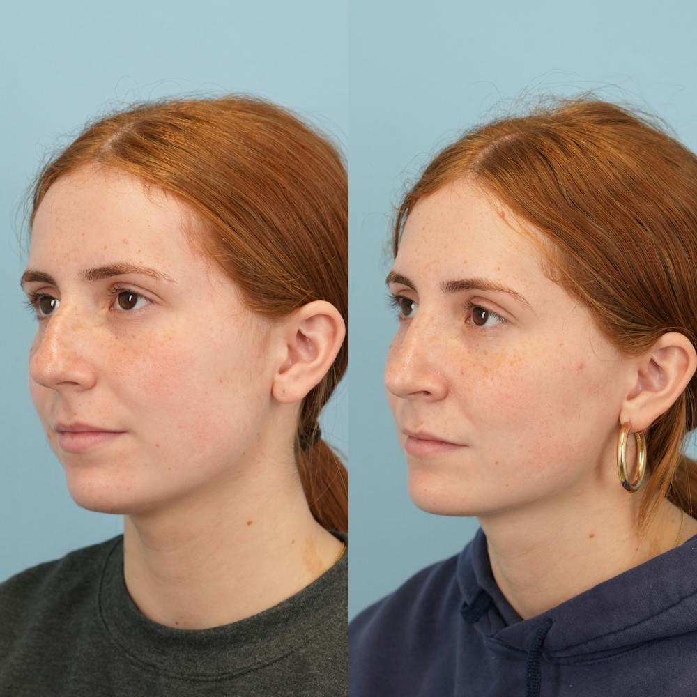 Blepharoplasty Before & After Gallery - Patient 221485 - Image 5