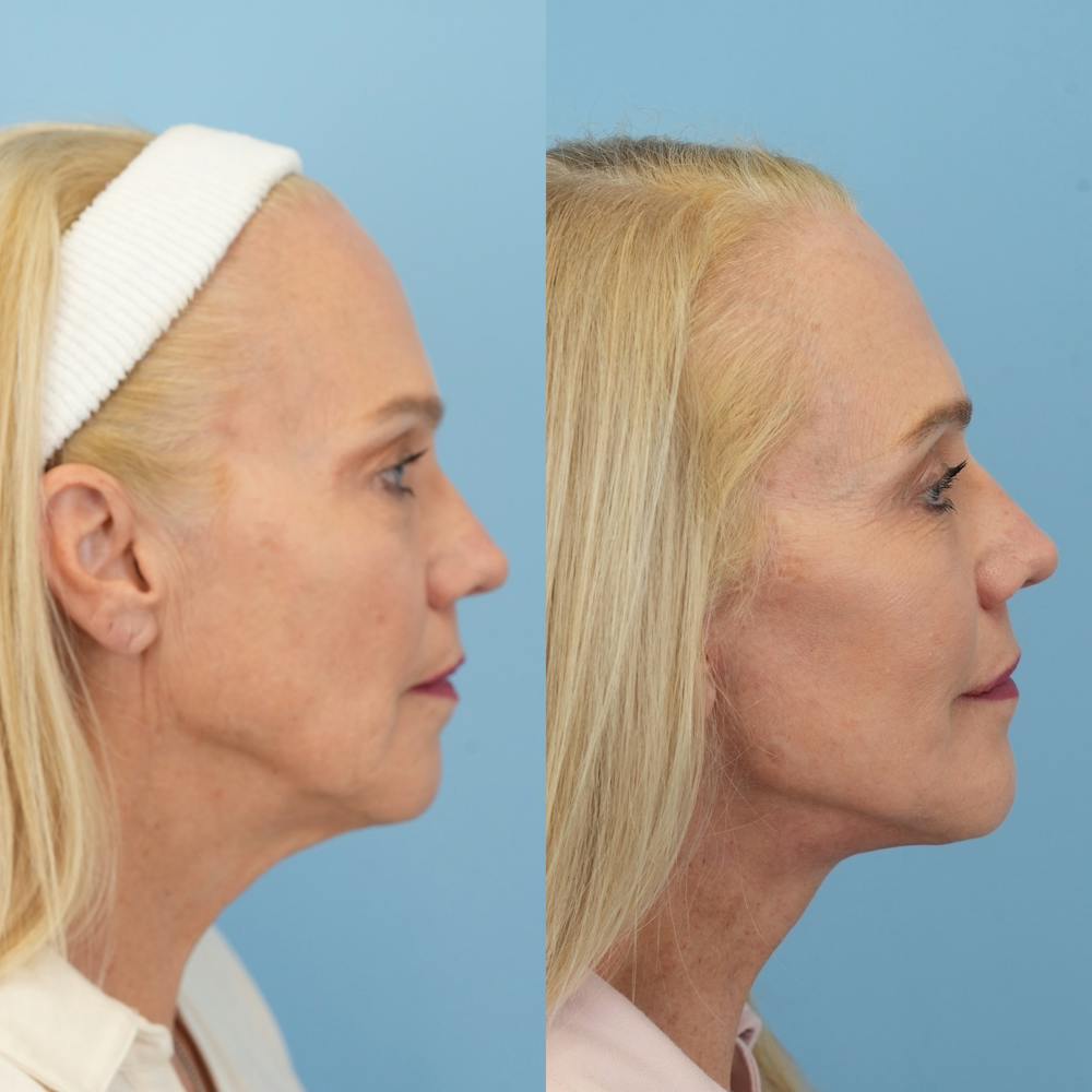 Facelift Before & After Gallery - Patient 417468 - Image 3