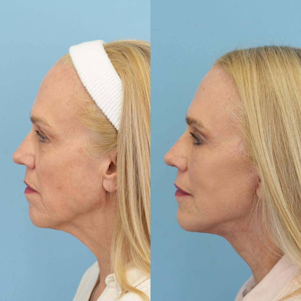 Facelift Before & After Gallery - Patient 417468 - Image 5