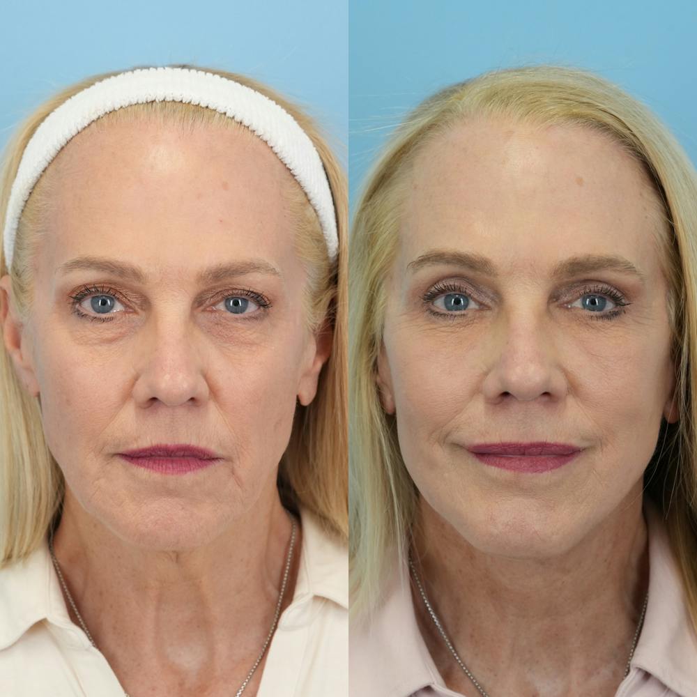 Facelift Before & After Gallery - Patient 417468 - Image 1