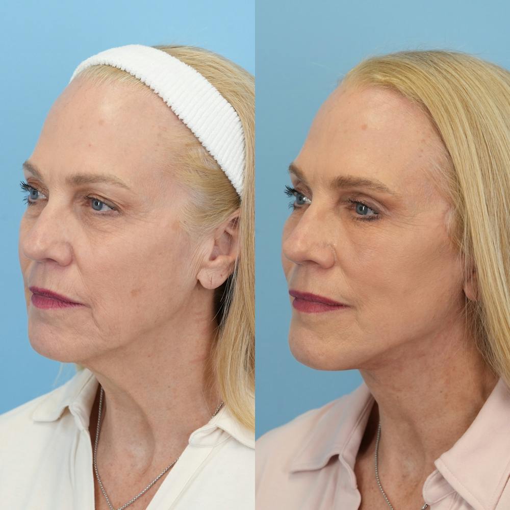 Facelift Before & After Gallery - Patient 417468 - Image 4