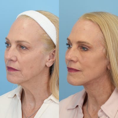 Facelift Before & After Gallery - Patient 417468 - Image 4
