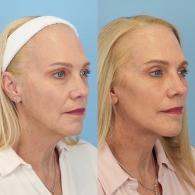 Facelift Before & After Gallery - Patient 417468 - Image 2